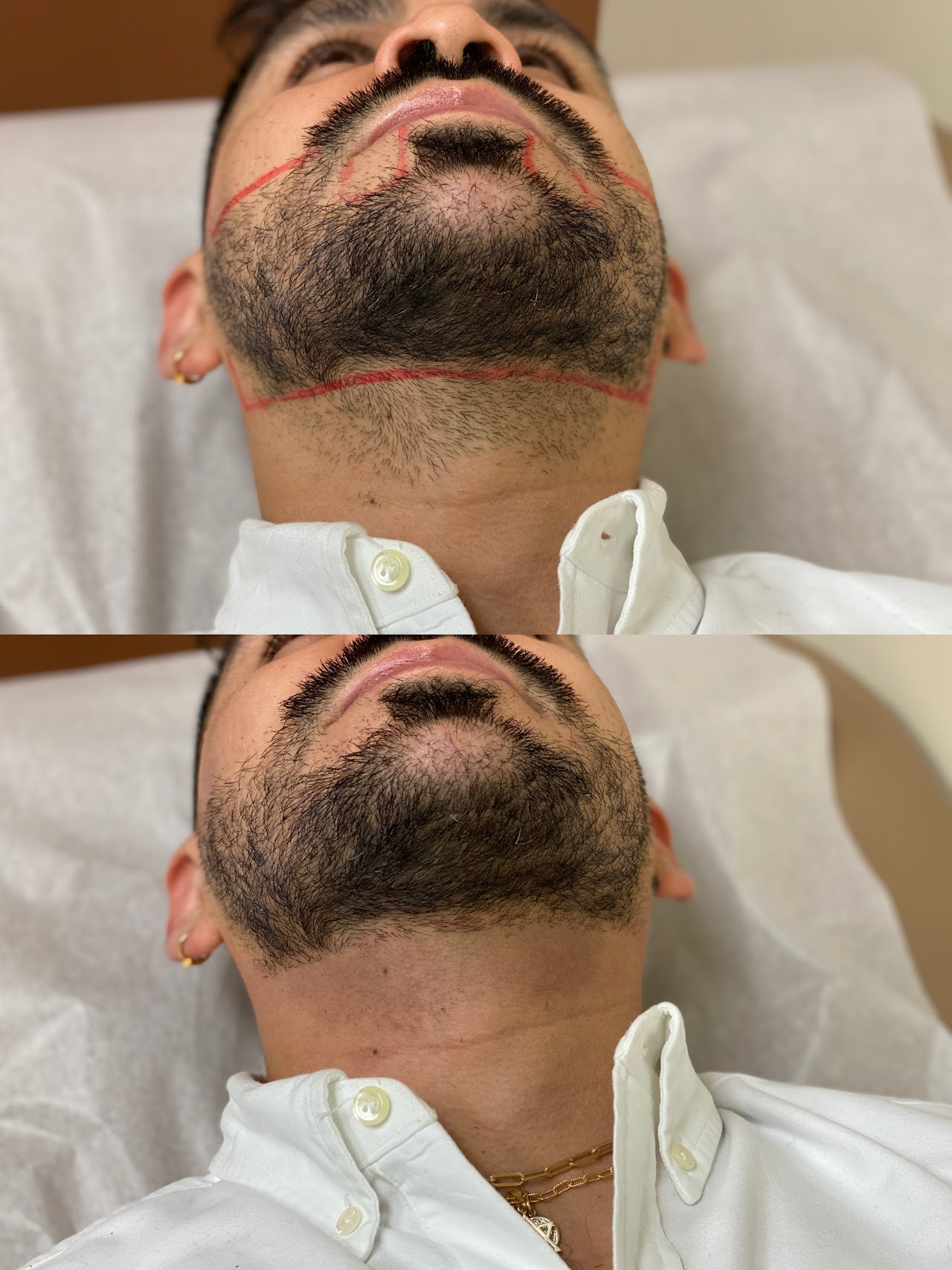 Microneedling service photo
